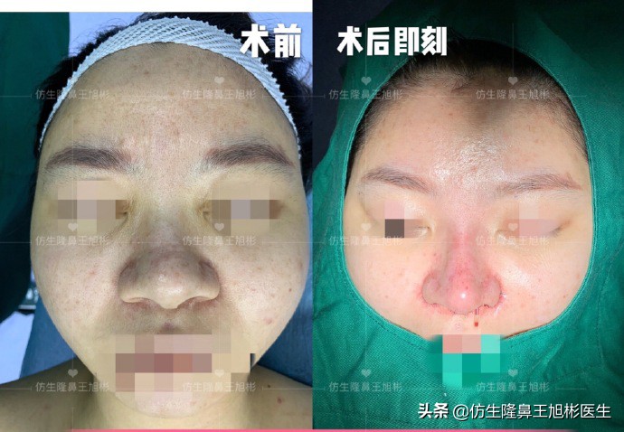 单纯隆鼻是什么，和综合隆鼻有什么区别？