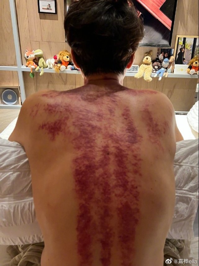 Ella晒与老公相爱相杀日常，怒批老公熬夜打游戏后，贴心帮其刮痧