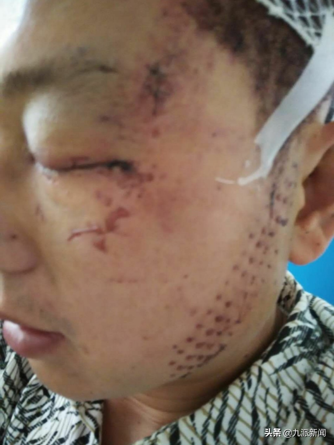 中学教师左眼被打失明，哥哥获刑一年缓刑两年，当事人指控实为嫂子抠的，但遭否认