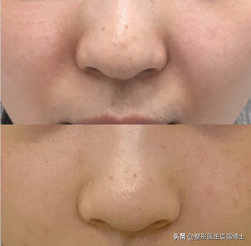 关于如何“消除”法令纹，整形医生有话说