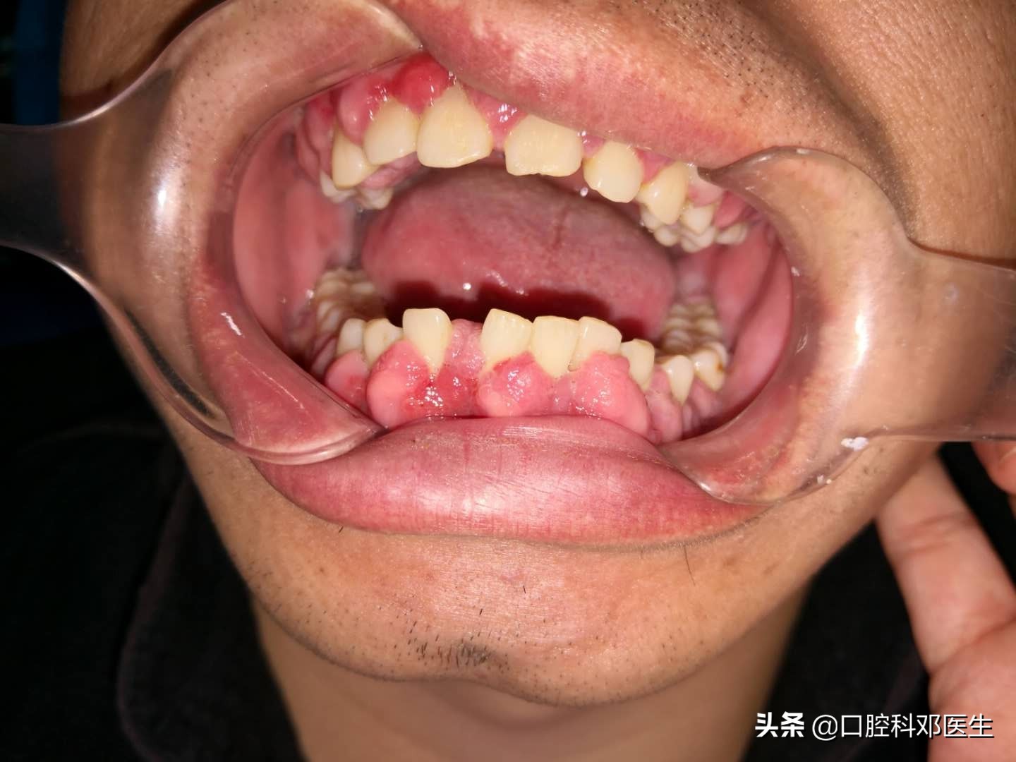 牙龈增生 骨质图片