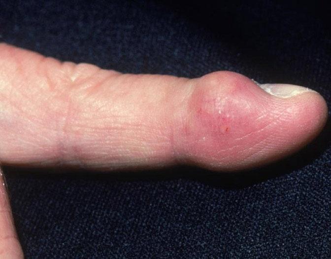 手指关节腱鞘囊肿图片(手部肿物) - 赤虎壹号