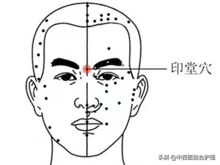 「穴位科普」印堂穴，可治疗脊柱上各部位病痛