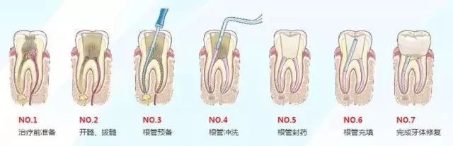 雅悦齿科：为什么根管治疗费用那么贵？那可全是牙医的技术啊！