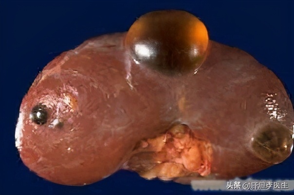 肝囊肿是指肝内单发或多发的囊性病变,临床上最常见的类型是单纯性肝