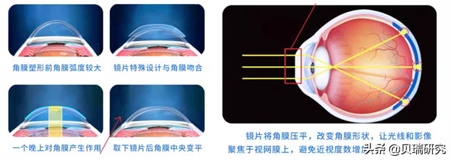 眼科不止连锁医院一个赛道，“魔幻暴利”的OK镜同样坡长雪厚