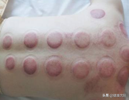 健康科普堂 | 拔罐讲义