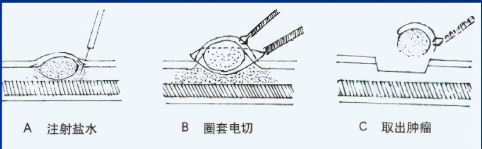 肠息肉 是怎样在内镜下切除的？