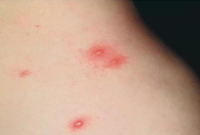 冬春季多发，斑疹、丘疹、水疱及结痂“四世同堂”，可能是水痘