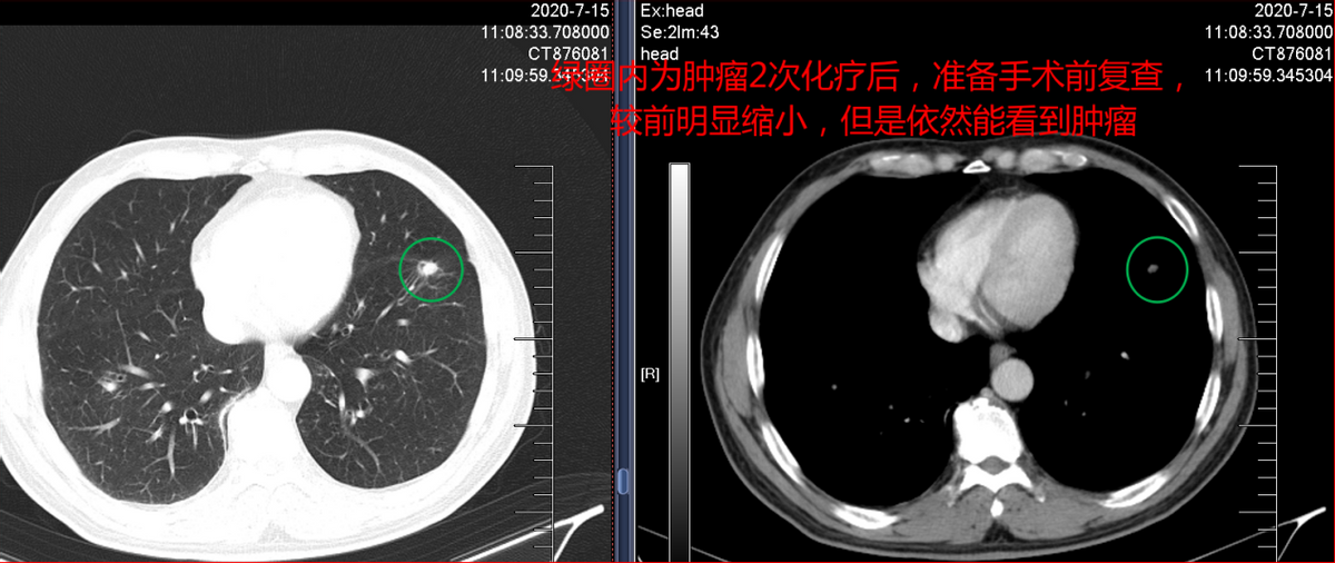 中医药联合化疗治疗肺腺癌取得奇效：肿瘤居然消失了