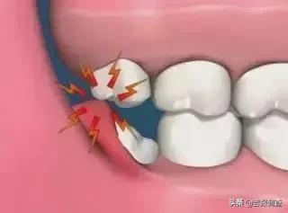 长了智齿到底拔不拔？长春市口腔医院专家给您支招啦