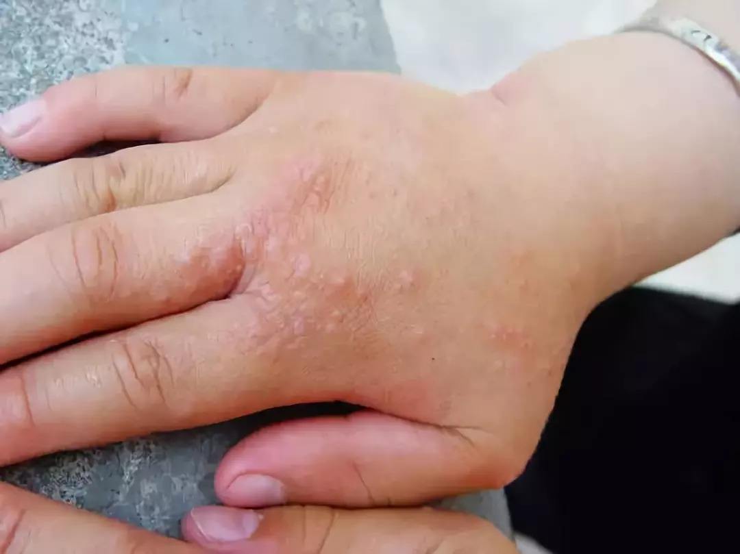孩子老是手蜕皮只是干燥吗？还可能跟这三种疾病有关，可别大意