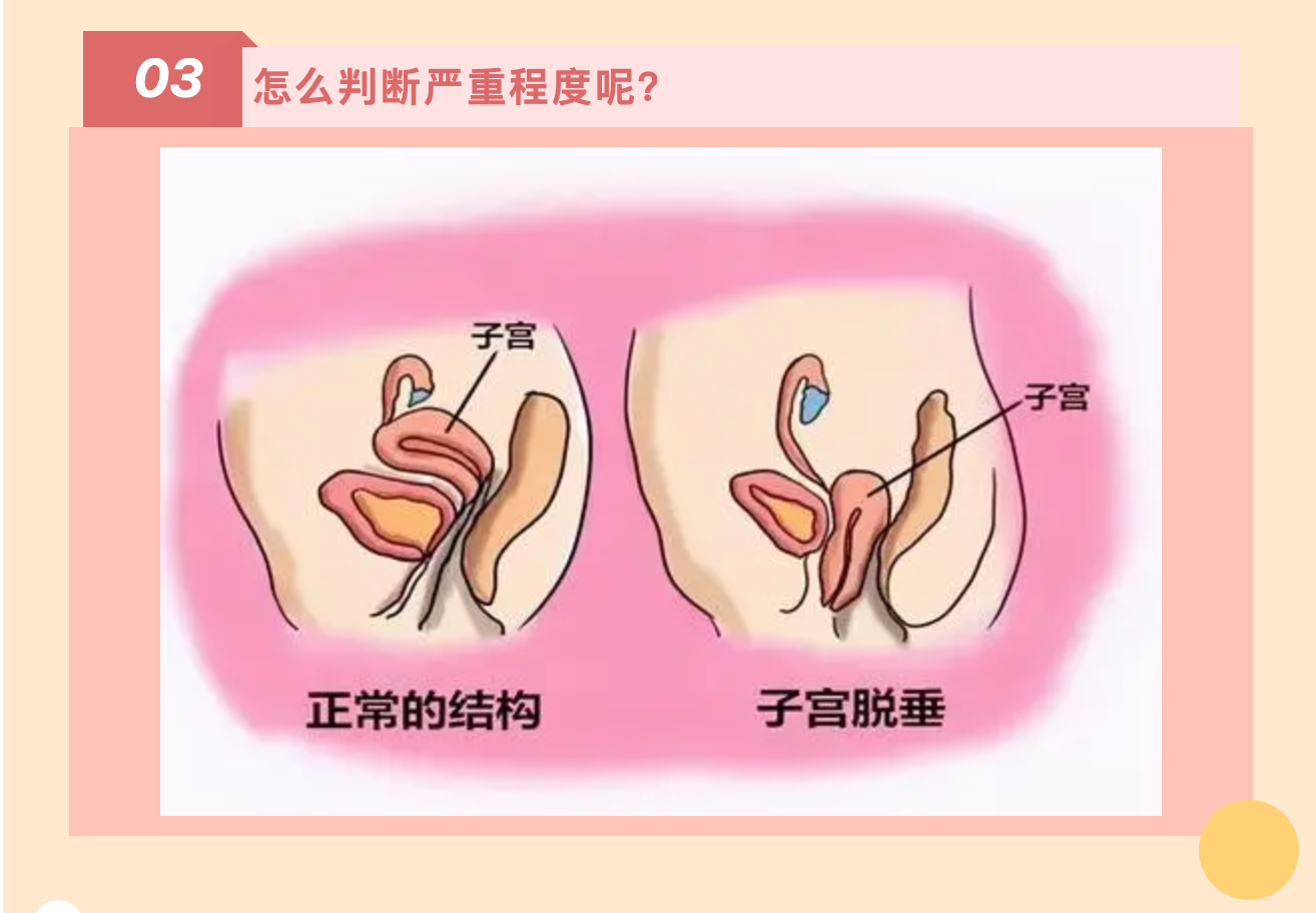 产后小腹总有下坠感，要警惕子宫脱垂啦