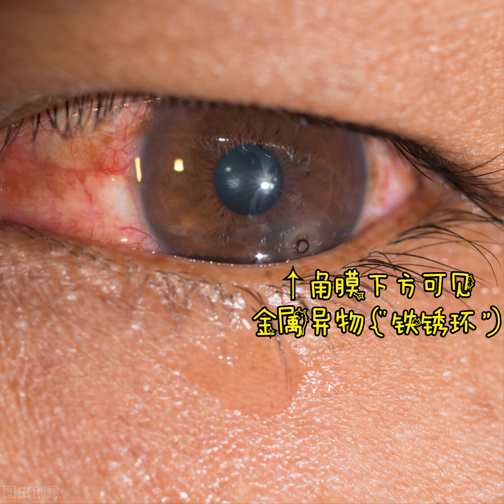 角膜异物是一种什么眼科疾病呢？又该如何处理呢？