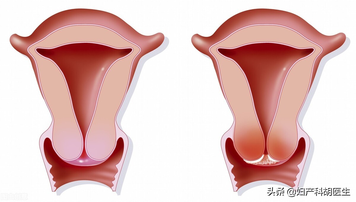 这种特殊宫颈癌你知道吗?