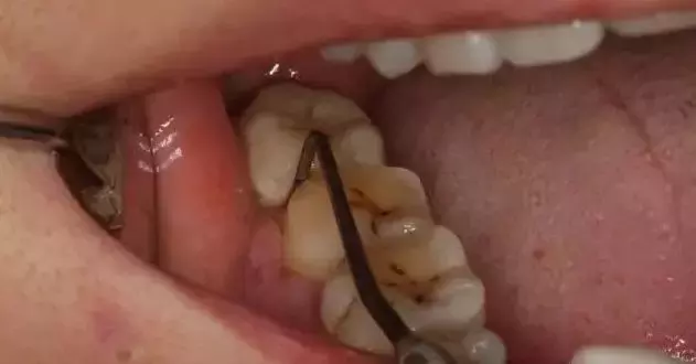 洗牙普通200,深度3000,深度洗牙是忽悠还是真的?