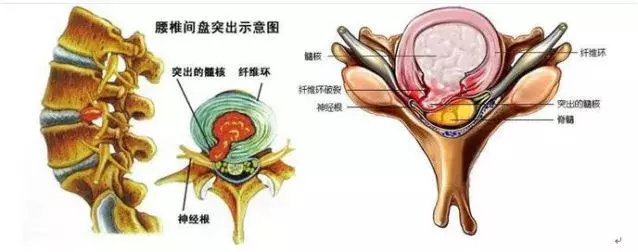 为什么足球比赛第2天腰酸(正美体态：引发腰痛的两大原因  闪了腰怎么办？)