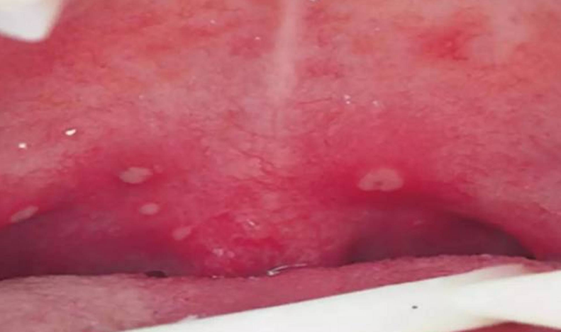 腭舌弓发炎图片(儿科医生谈儿童夏季常见疾病) - 赤虎壹号