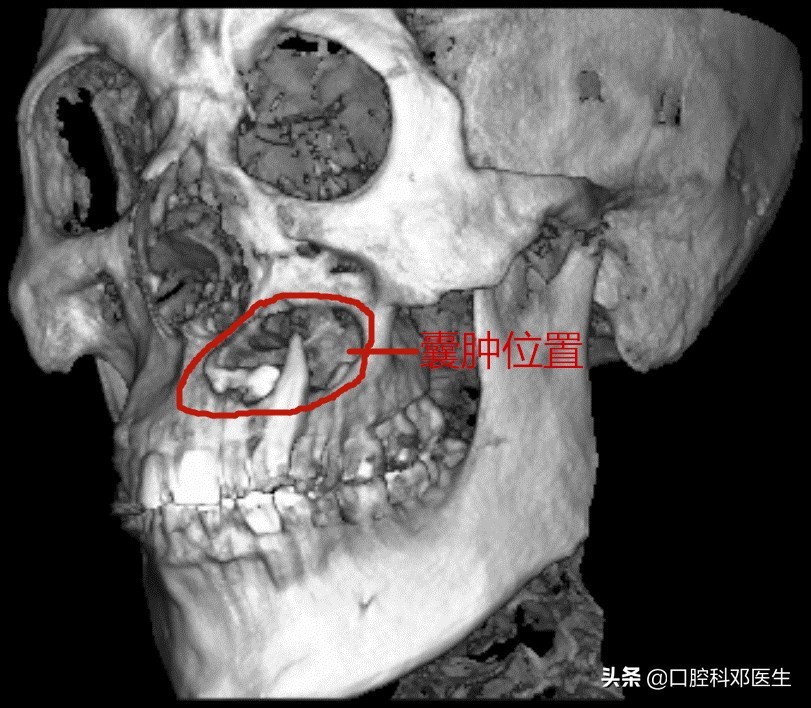 埋伏阻生牙不拔除，长期埋伏隐患多！