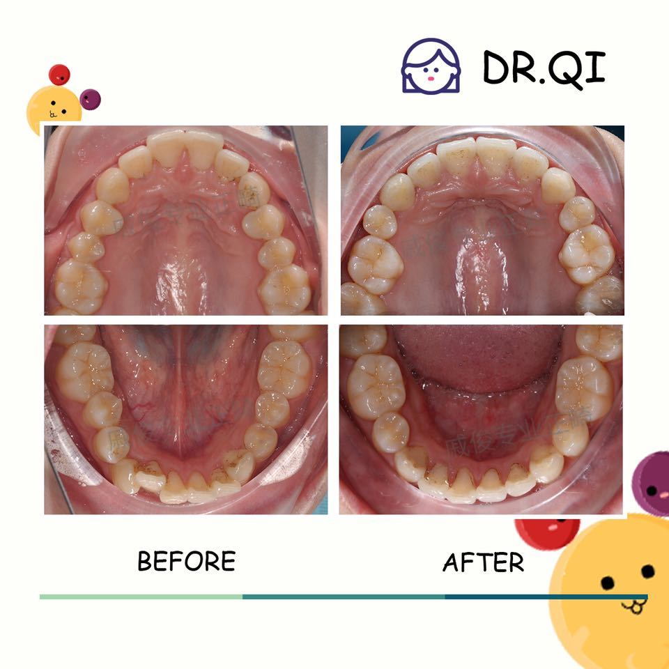 广州牙齿矫正戚俊医生|上颌前突病例合辑(一)