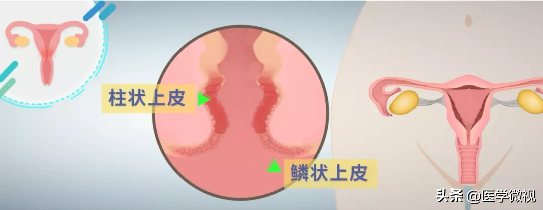 宫颈糜烂是病吗？小编化身密探，明查暗访，揭秘医疗大骗局