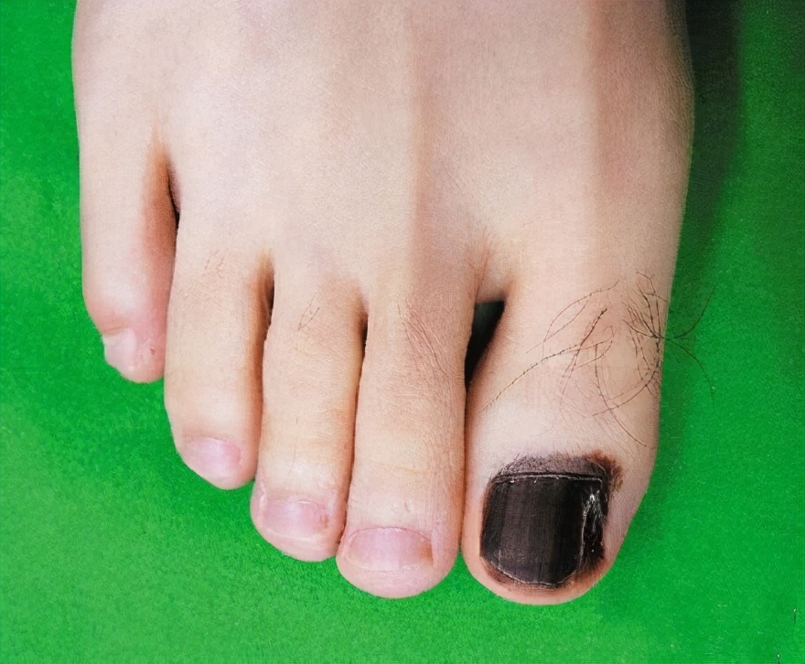 1,指甲有黑色竖线上述案例中刘女士指甲上的黑线,医学上叫甲黑线,是甲