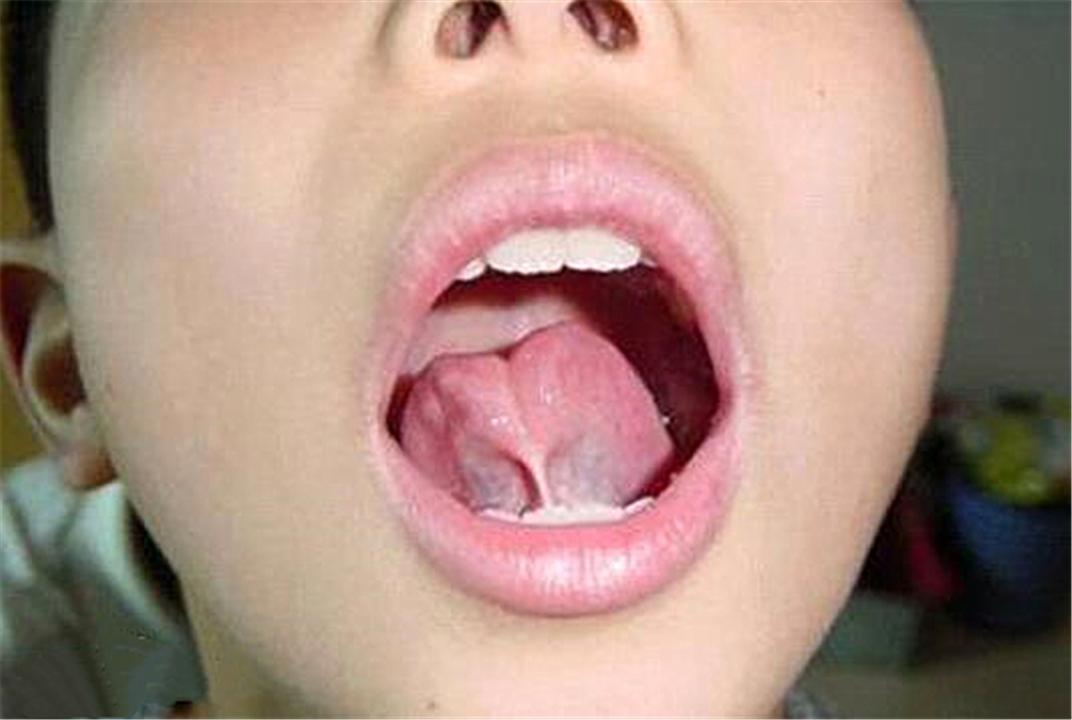 婴儿舌头尖有点凹图片(2) - 乐宝宝贝