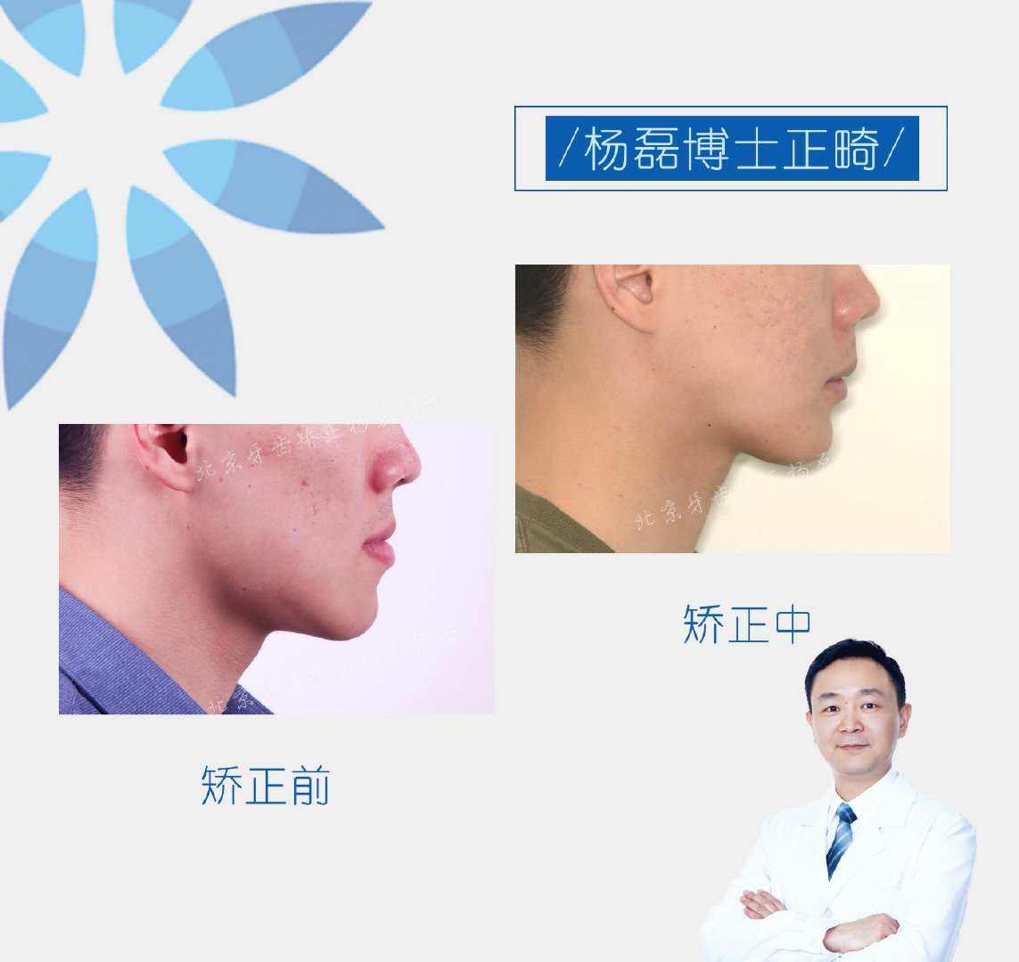​​杨磊博士 「骨性反颌偏颌正畸正颌联合治疗病例」