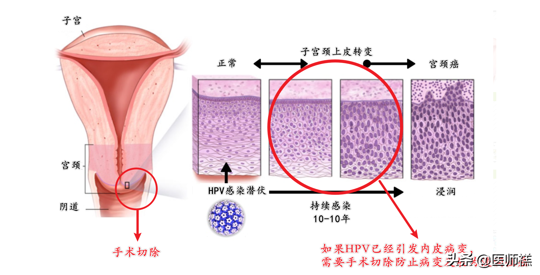 HPV疫苗一定要选九价？少花钱少排队二价疫苗比九价更值得