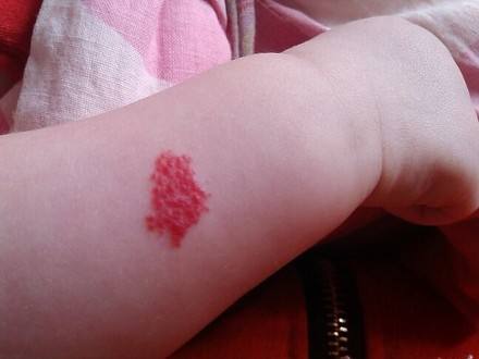 宝宝生下来头部有红色胎记怎么办?可能是血管瘤,可以先观察