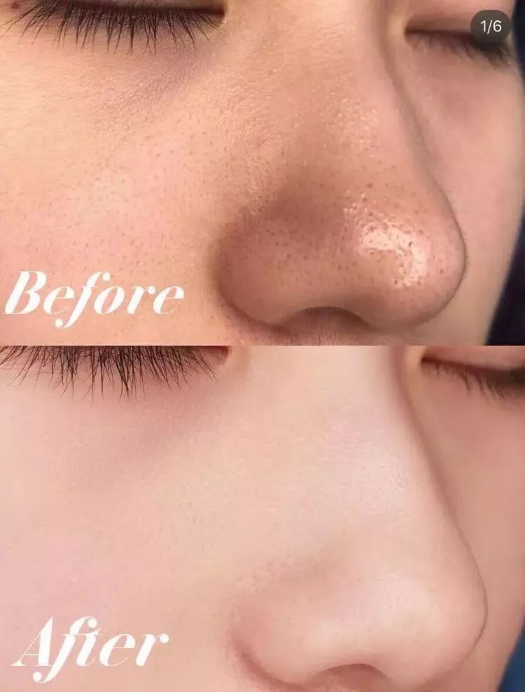 脸上泛红发痒、出油长痘？“螨虫脸”真的很丑，除螨刻不容缓