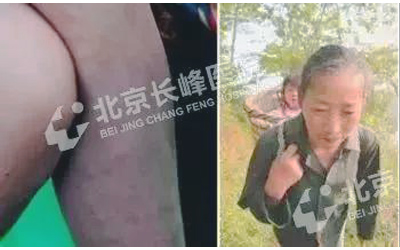 幼儿脸上红斑是胎记？不用治？记住下面三点，教你轻松辨别血管瘤