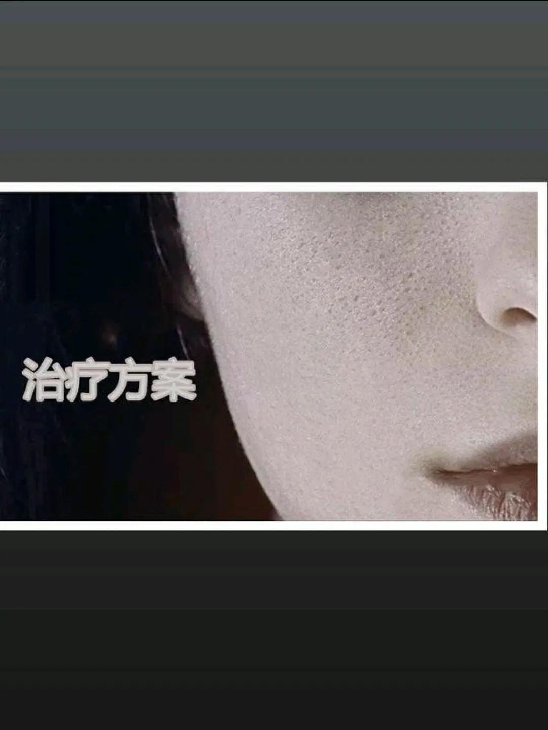 毛孔粗大还有救吗？你知的缩毛孔方法都没用