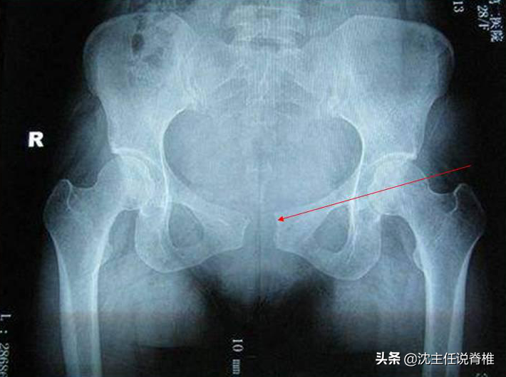 孕妇耻骨位置图，孕期耻骨疼怎么缓解