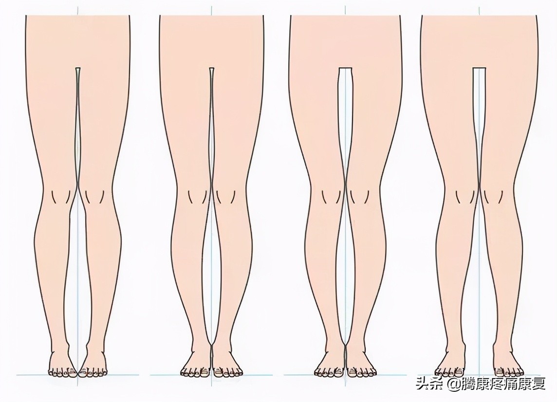 五个改善骨盆前倾的矫正拉伸训练