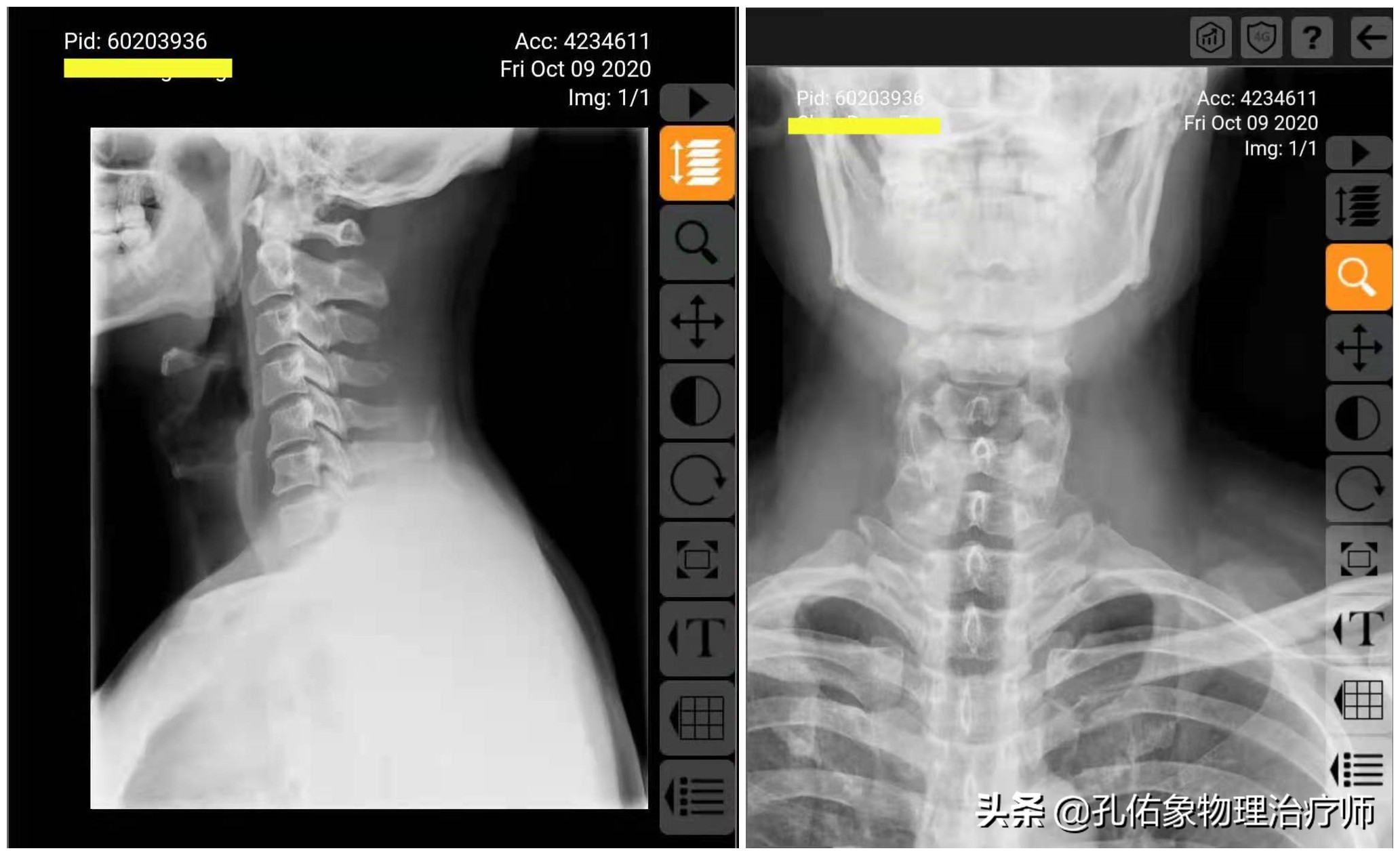 颈椎病很困惑，要如何治疗呢？一文详细告知您不一样的策略方法