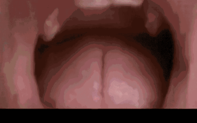 你知道“小巨蛋”吗？10s抗糖美白牙齿，效果比洗牙好太多了