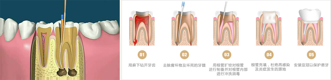 根管治疗的价格为何相差这么大？跟这4个问题息息相关