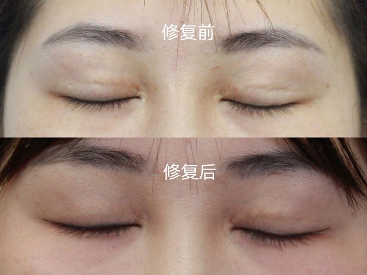 双眼皮疤痕增生图片(双眼皮术后瘢痕明显的原因分析及修复对策)