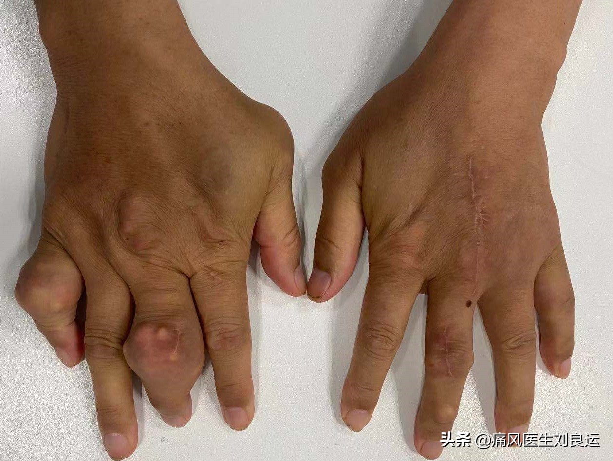 痛风急性发作只会在大脚趾上?不,手脚等四肢关节都可能发作
