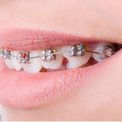 地包天牙齿矫正需要多少钱(地包天的最佳矫正时间是什么时候) - 价格