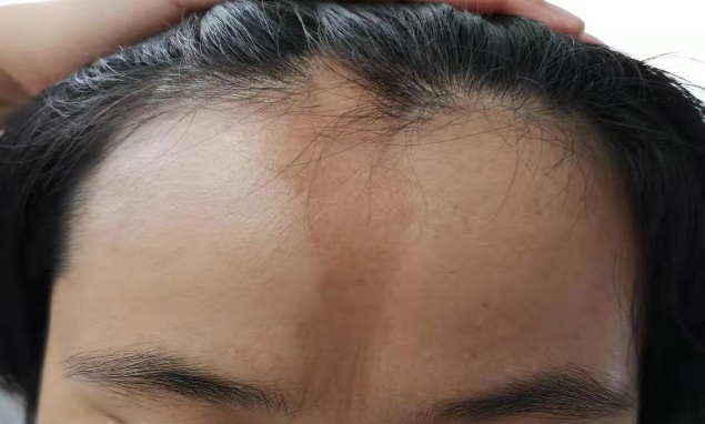 如何早期识别局限性硬皮病?一文说清(内附图片)