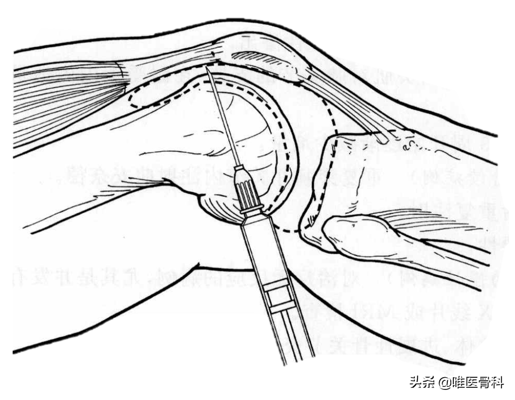 打“玻璃酸钠”对身体会有哪些影响？要注意这 5 点