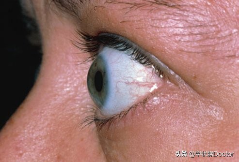 甲亢,甲减别再傻傻分不清了!一文给你讲明白了