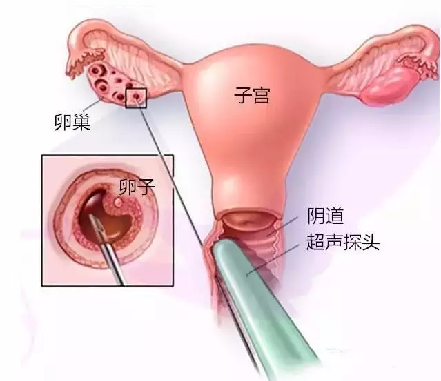 “我”想冻卵，冷冻的卵子，真的是女性生育的“防腐剂？