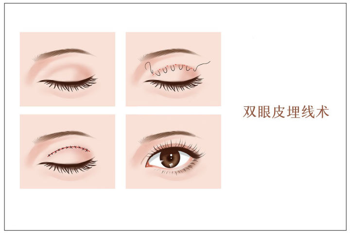 使用双眼皮贴可以贴出来双眼皮是真的吗？