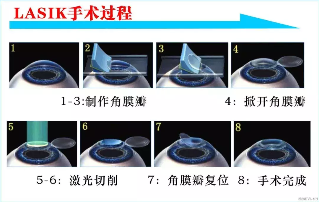 “近视手术毁了我”,他们选择自杀,原来这种手术比想象的危险!
