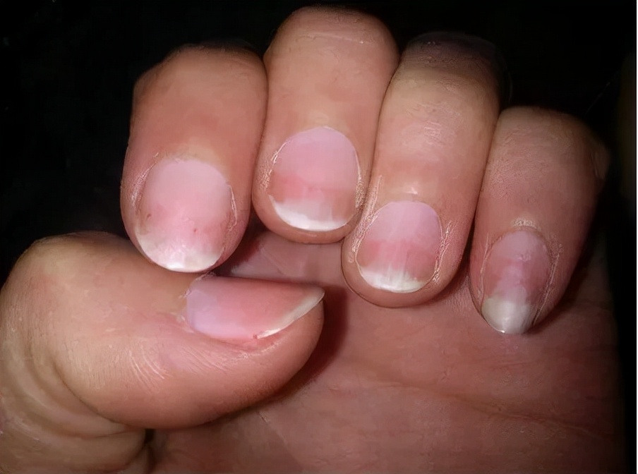 指甲长这样,是癌症的信号?别不信!