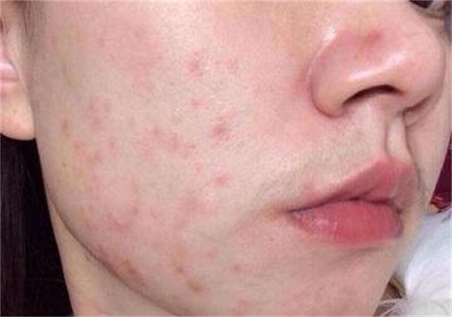 过敏了还是变成了敏感肌?