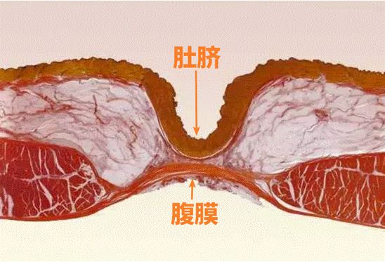 肚脐眼，真的会“进风”吗？